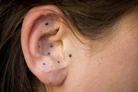 Auriculoterapia: técnica de estimulação de pontos específicos da orelha
